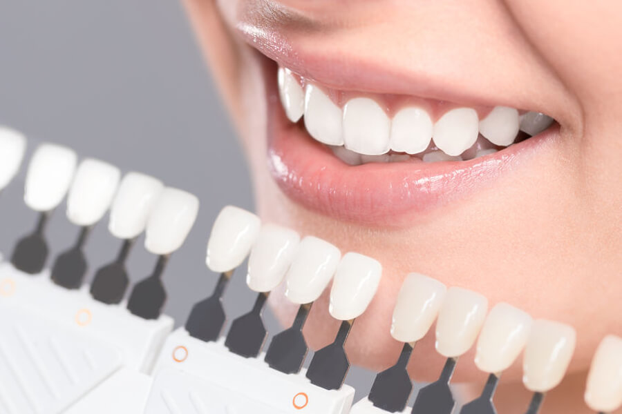 dental verblendungen - dental veneers - fatete dentare: Molnar Dental Sopron Ungaria