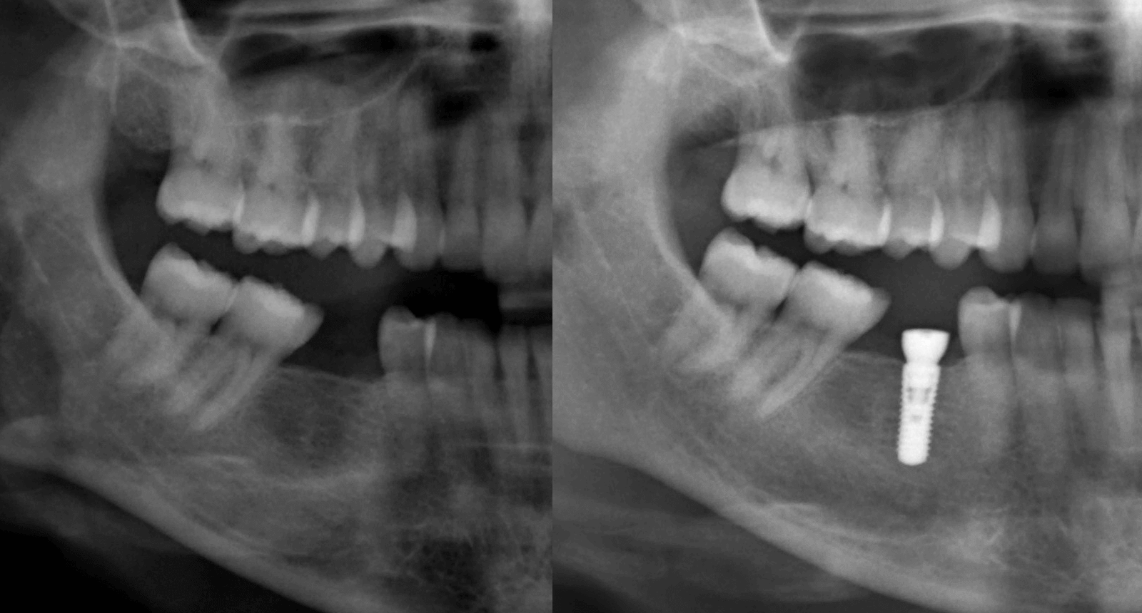 Implantul dental radiografii (x-ray)